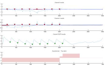 Abbildung 3: Zwei EKG-Signale und ein PPG-Signal mit Asystolie. 