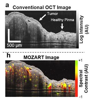 Figure 1. Top: A conventional OCT image, showing the tissue structure of a tumor in the ear pinna of a live mouse. Bottom: A MOZART image of the same tissue region. The spectral analysis reveals LGNRs in the blood vessels.