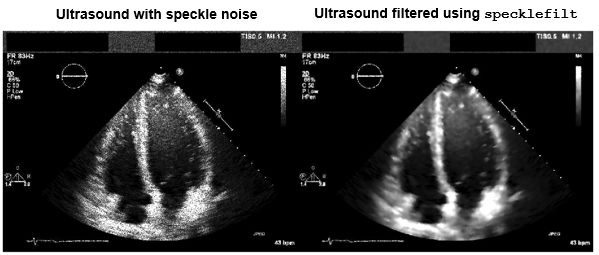 Side-by-side comparison of original ultrasound and ultrasound with speckle noise filtered out.