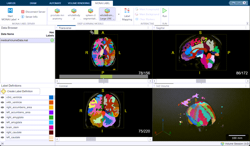 Software screenshot showing medical image processing of a brain using 3D segmentation.