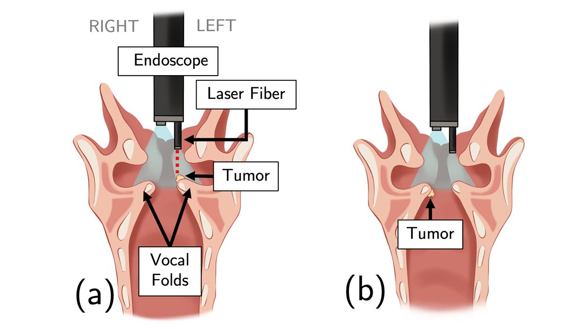 One illustration shows a tumor above the vocal fold that is in sight of the flat laser fiber. The second illustration shows that if the tumor is below the vocal fold it is blocked by the fold and can’t be seen.