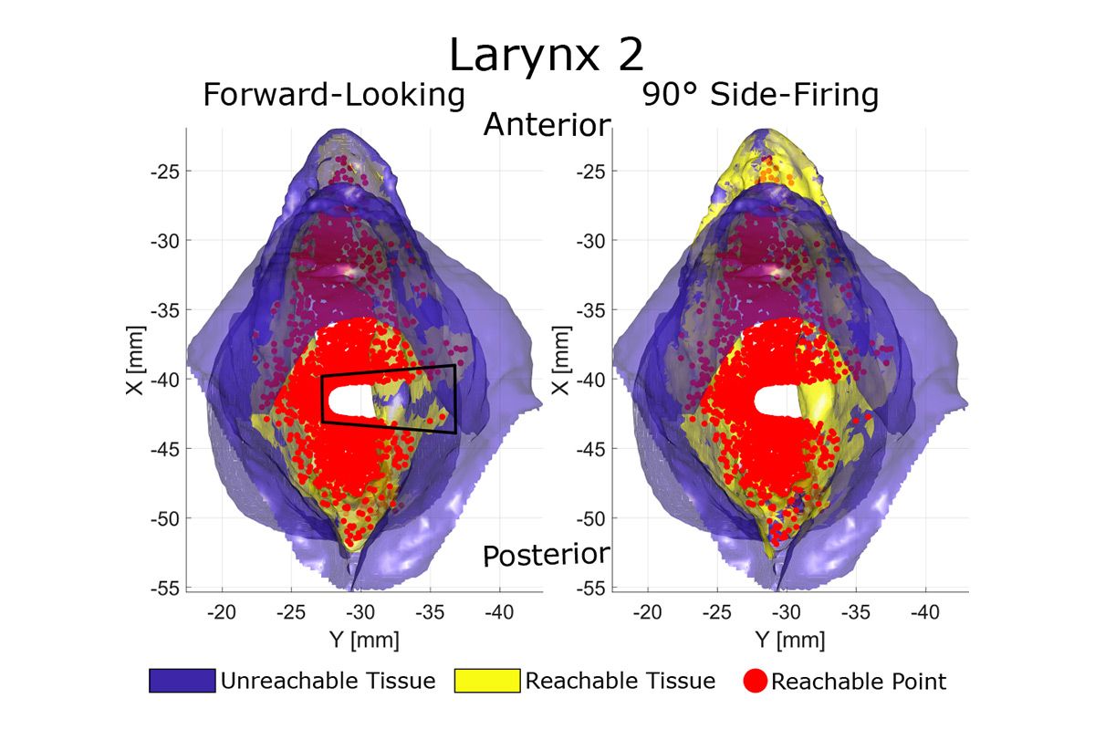 Larynx simulations that compare the areas reachable by forward-looking fibers versus 90° side-firing fibers and show the gap that was previously unavailable to the forward-looking fibers. 