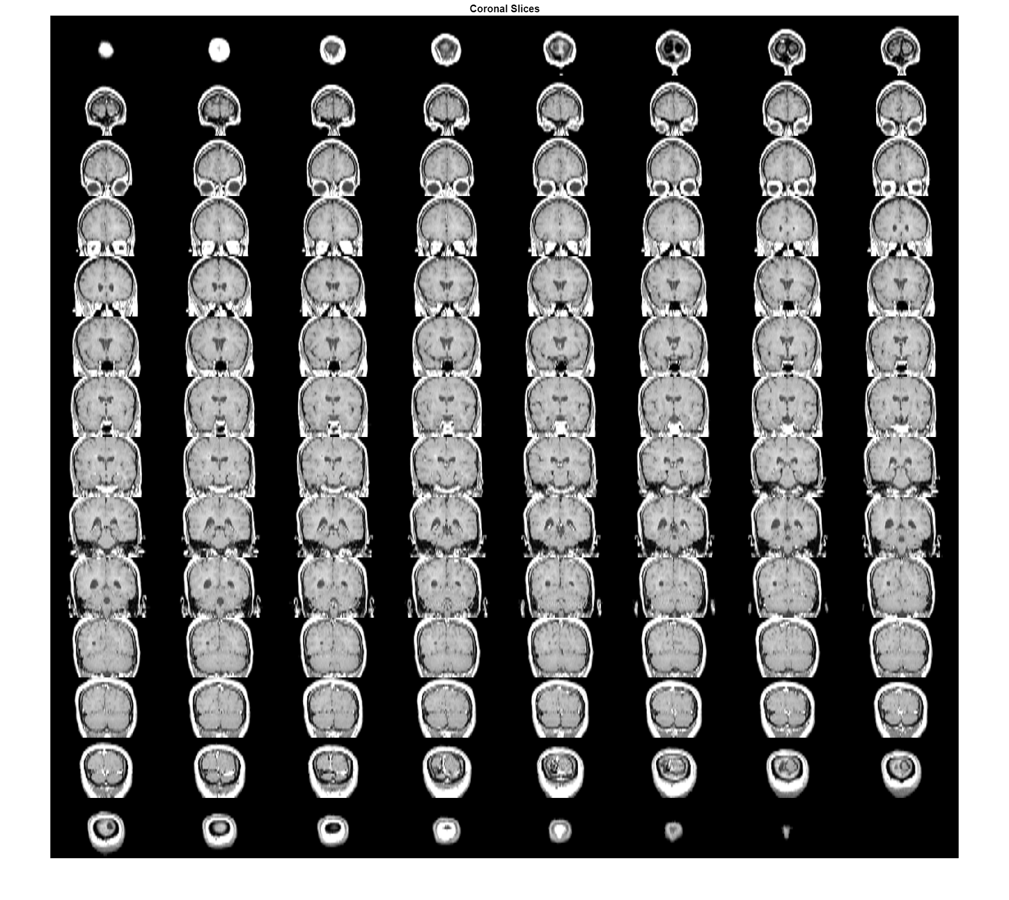 Figure contains an axes object. The axes object with title Coronal Slices contains an object of type image.