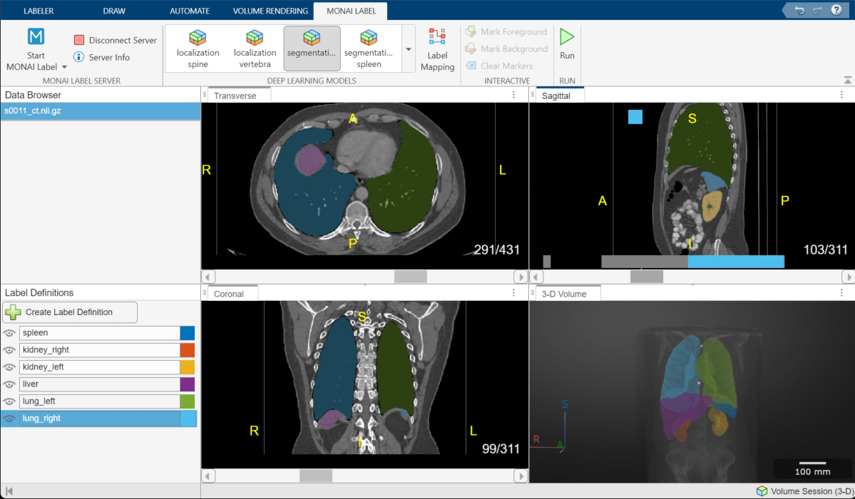 Medical Image Labeler window with a red circle that indicates areas of the spleen label that need refinement.