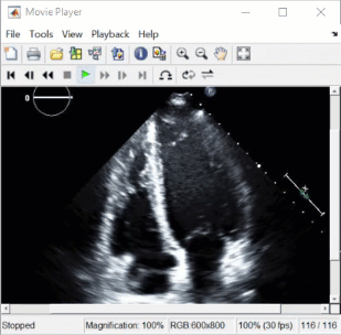 Ultrasound echocardiogram