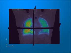 PET volume overlaid on CT volume in a slice planes volume display.