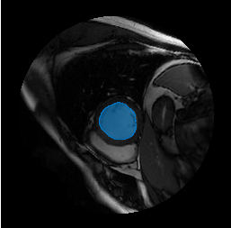 MedSAM segmentation mask